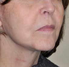 Your first day sets the tone for the next five weeks. Facelift Surgery Top Facelift Surgeon Dr Barry Eppley