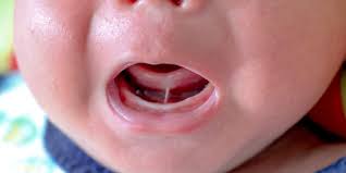 How do i care for my child's teeth? What Is Tongue Tie Why It S A Problem And When To Treat It