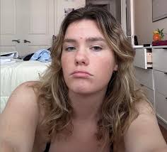 i am 26 and i have a pimple.