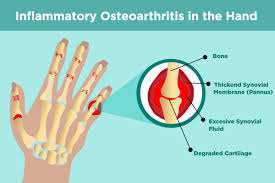 Treatment of osteoarthritis of the knee. Understanding Erosive Osteoarthritis Causes Symptoms Treatment