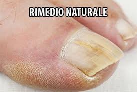 Addio Alle Infezioni Di Funghi Ecco 3 Rimedi Semplici E Naturali Per Il Trattamento Dell Unghia Del Piede Repubblica 24 Rimedi Rimedi Naturali Naturale