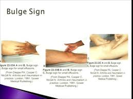 Image result for Knee Bulge Sign