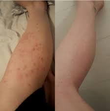 9 Products That People Actually Use To Solve Beauty Problems Ingrown Leg Hair Ingrown Hair Ingrown Hair Remedies