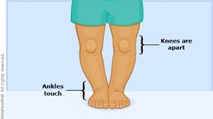 Image result for Genu Varum