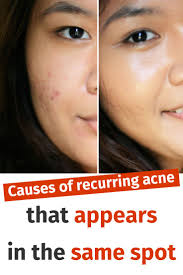 I've had luck not using am i purging? Pin On Skincare Tutorials