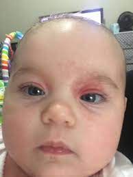 Eczema On Eyelid May 2019 Babies Forums What To Expect