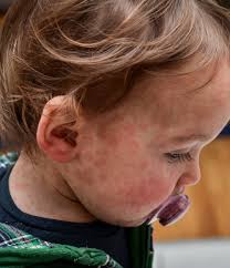 Image result for Measles