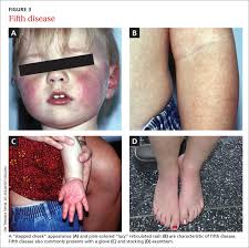 8 viral exanthems of childhood