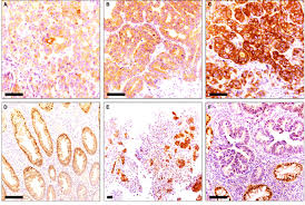 Cancer can also cause the immune system to react in ways that produce these signs and symptoms. Representative Examples Of Ve1 Staining In Colorectal Cancer Biopsy Download Scientific Diagram