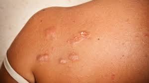 There are currently 34 tattoo removal + keloid scar questions and doctor answers on realself. Keloid Scars Risks Causes Prevention And Treatment