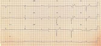 It is sometimes confused with an echocardiogram. Killer Ecg Patterns Litfl Medical Blog Ecg Library