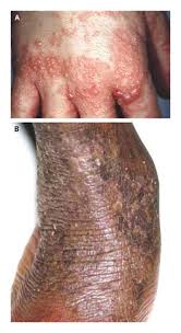 Image result for Atopic eczema atopic dermatitis