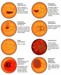 Retinal Haemorrhage 01 Retina Boat Thumbprint Subhyaloid Dot Blot Eye Facts Eye Health Optometry