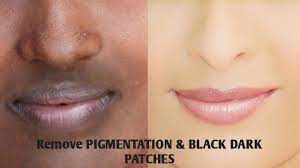 Dec 05, 2017 · these dark skin patches are called liver spots, sun spots, dark spots, age spots, and brown spots. Remove Pigmentation Black Dark Patches Home Remedies For Pigmentation On Face In Tamil Youtube