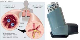Nk Cells Are Responsible For Releasing Cytokines That Cause Airways To Constrict And Fill With Mucus During An Asthma Attack Asthma Treatment Albuterol Asthma