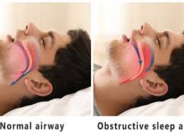 Image result for Sleep Apnea