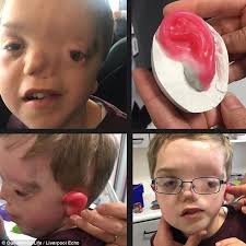 Stoke mother reveals son with Goldenhar syndrome's abuse