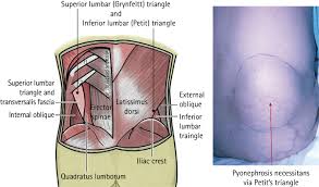 Image result for Perinephric Abscess