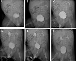Image result for Voiding Cystourethrogram