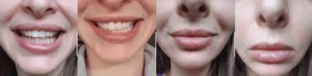 Straightening your teeth can be easy and. Plastic Surgeon Dr Dean Kane Of Baltimore Answers Question Regarding Lopsided Smile Following Botox Dr Dean Kane