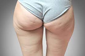 Finden sie cellulite treatments auf gigagünstig! 7 Proven Ways To Get Rid Of Cellulite Fast For A Sexy Body
