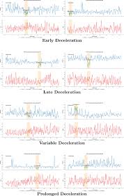 Image result for Late Deceleration