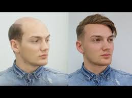 From Baldness to Trend Hairstyle 2017