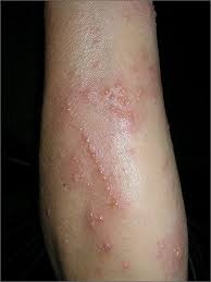 Image result for Rhus Dermatitis