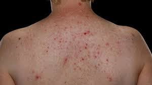 Cara menghilangkan bekas jerawat di badan. Begini Cara Mengatasi Jerawat Di Punggung Cukup Pakai Bahan Alami Ini Tribun Cirebon