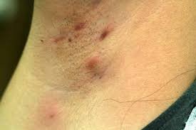 On one end, they resemble a pimple with a raised pore and whitish bump on top. Ingrown Armpit Hair Lymph Node Pictures Lump How To Get Rid Home Remedies Symptoms Infected Underarm Boil