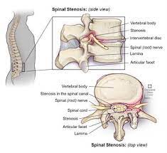 Spinal Stenosis What Is It Symptoms Causes Treatment Surgery
