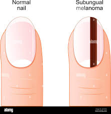 Image result for Acral lentiginous melanoma nail