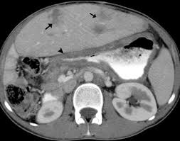 Imaging Of Chronic Granulomatous Disease In Children Radiographics