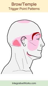 Brow Temple Archives Integrative Works In 2020 Trigger Points Headache Migraines Remedies