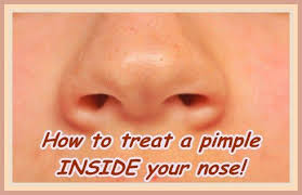 Acute vestibulitis is characterized by redness and swelling of the nostril. If You Have Ever Suffered From A Pimple Or A Spot Inside Your Nose Actually Inside A Nostril You Will Know How Acne On Nose Nose Pimples Pimple Inside Nose