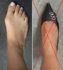 Does wearing small shoes make your feet smaller? Tight Shoes And Foot Problems Orthoinfo Aaos
