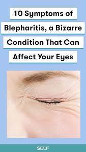 10 Symptoms Of Blepharitis A Bizarre Condition That Can Affect Your Eyes Blepharitis Allergy Eyes Itchy Eyelids