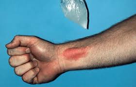 Maybe you would like to learn more about one of these? Welts On Skin Due To Cold Temperature Could Be Hives