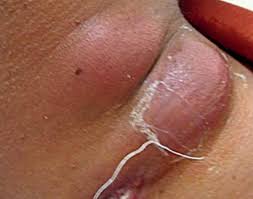The arms and feet were involved in three. Scielo Brasil Cutaneous Tuberculosis Epidemiologic Etiopathogenic And Clinical Aspects Part I Cutaneous Tuberculosis Epidemiologic Etiopathogenic And Clinical Aspects Part I