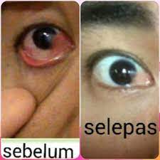 Mata kucing kamu terdapat selaput putih? Tips Merawat Masalah Rabun Dan Selaput Mata Posts Facebook