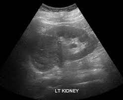 The detection rate of rccc with conventional ultrasound was about 71%, while the rate using ceus was 100%. Chromophobe Renal Cell Carcinoma Radiology Case Radiopaedia Org