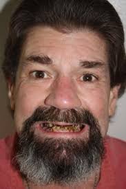 Introduction to Snap-On Smile