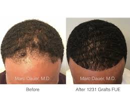 A hair transplant is the best way to get more hair on your head. Fue Hair Transplant In African American Patient Marc Dauer Md Hair Transplant Doctor Los Angeles