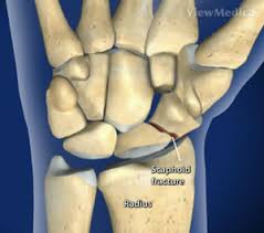 Image result for Scaphoid Bone