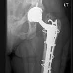 Cable–plate fixation of periprosthetic fracture | Download ...