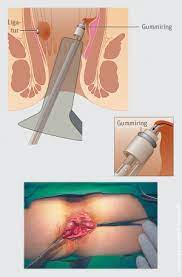 Inhalt hämorrhoiden, hämorriden, hämoriden oder hemoriden hämorrhoiden, allgemeine ratschläge hämorrhoiden, hämorriden, hämoriden oder hemoriden. Hamorrhoiden