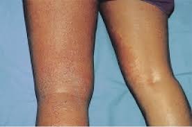 Image result for dermatitis contacta allergica