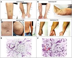 Clinical And Molecular Investigation Of Familial Multiple Lipomatosis Ccid