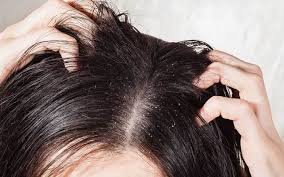You do not have to add an additional powdered hair mask or a creamy hair conditioner. The Truth About Anti Dandruff Hair Oils Skinkraft