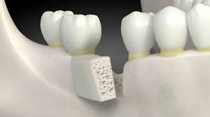 Bone Graft Before Dental Implants Cost And Procedure
